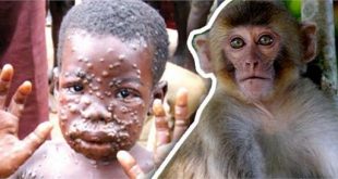 monkeypox